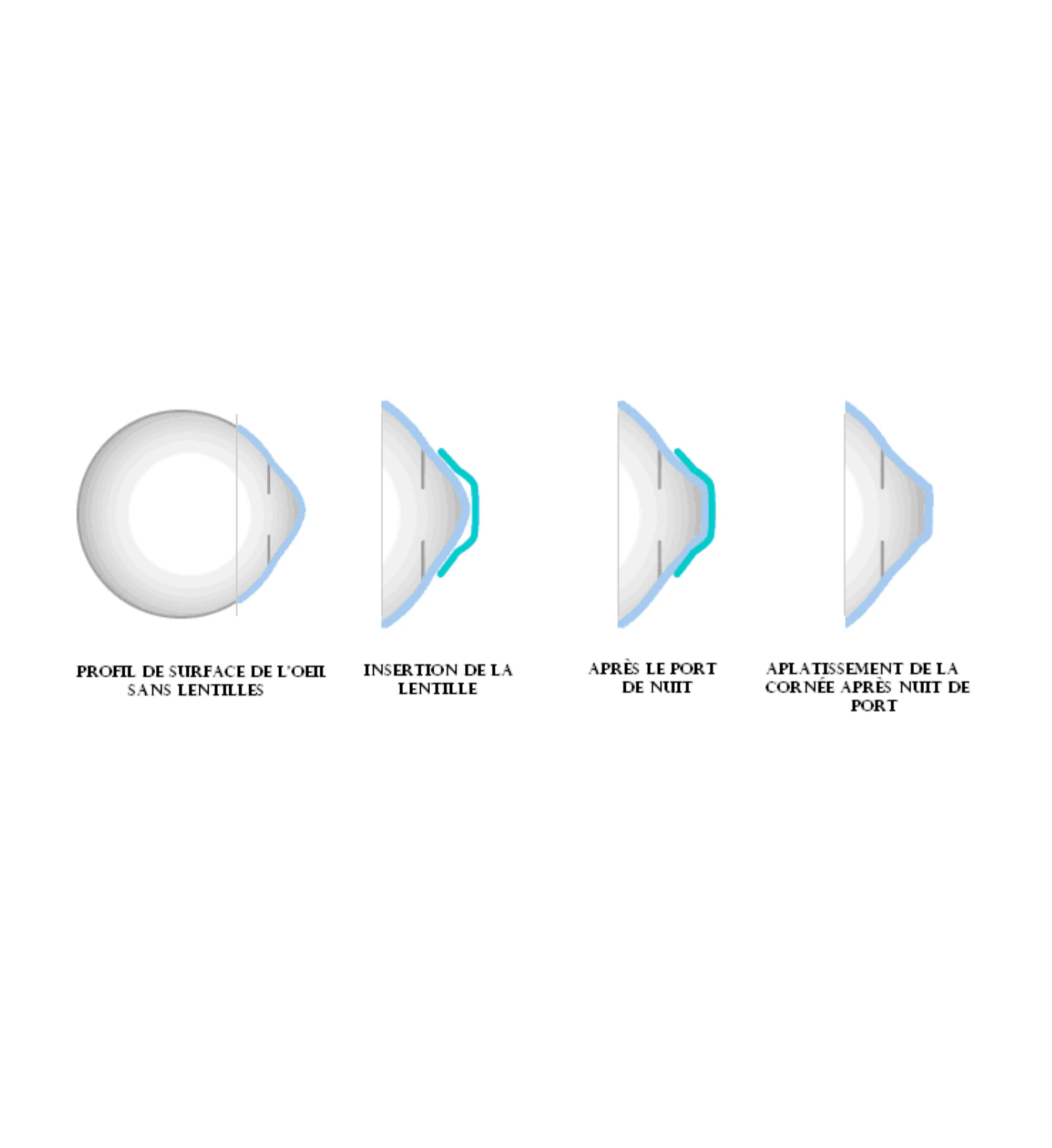 Traitements visuels - Orthokératologie - OPHTA CMC LEMAN Traitements visuels - Orthokératologie - OPHTA CMC LEMAN