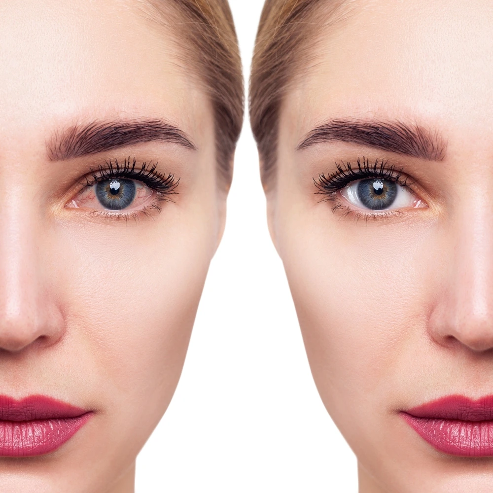 Traitements visuels - Sécheresse oculaire - OPHTA CMC LEMAN Traitements visuels - Sécheresse oculaire - OPHTA CMC LEMAN