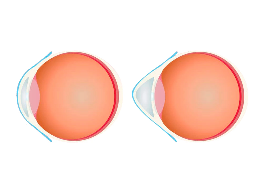 Traitements visuels - kératocône - OPHTA CMC LEMAN Traitements visuels - kératocône - OPHTA CMC LEMAN